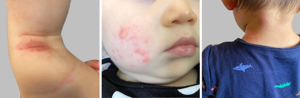 乳児のアトピーの症状