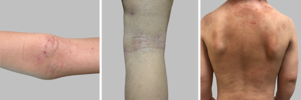 幼児期～学童期のアトピー症状