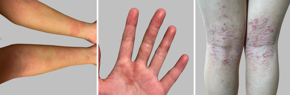 思春期・成人期のアトピー症状