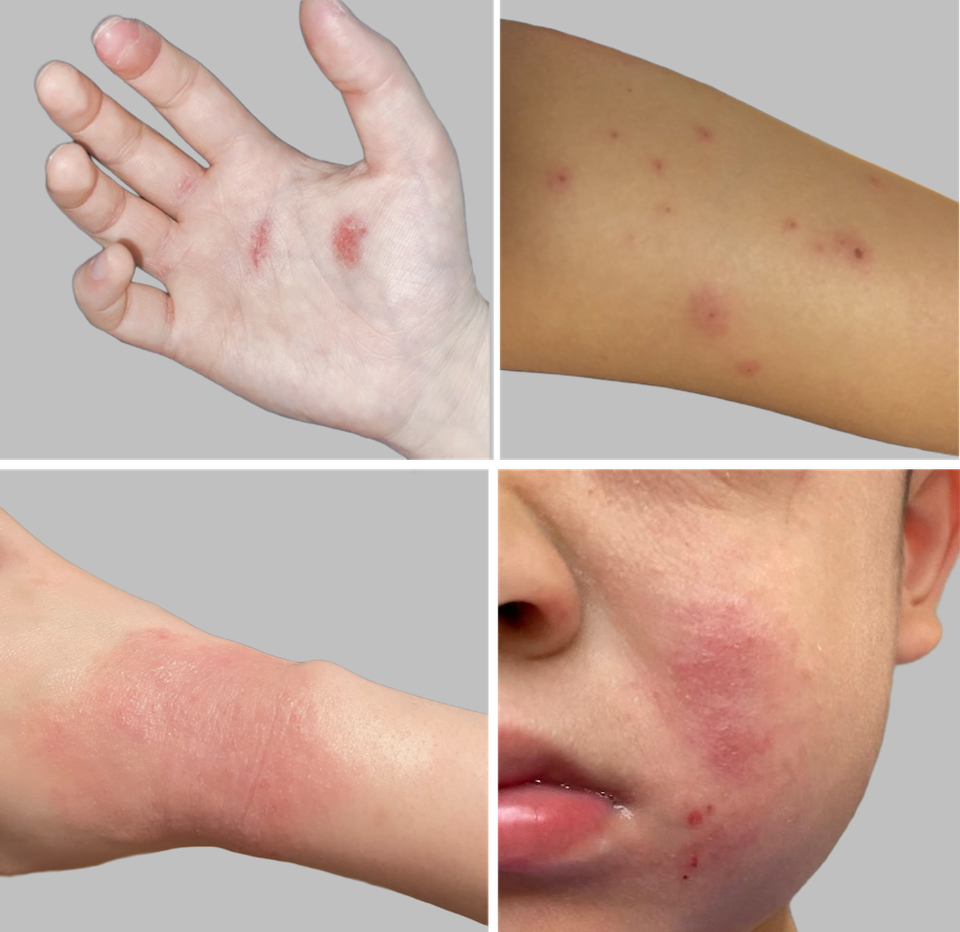 アトピーの代表的な症状